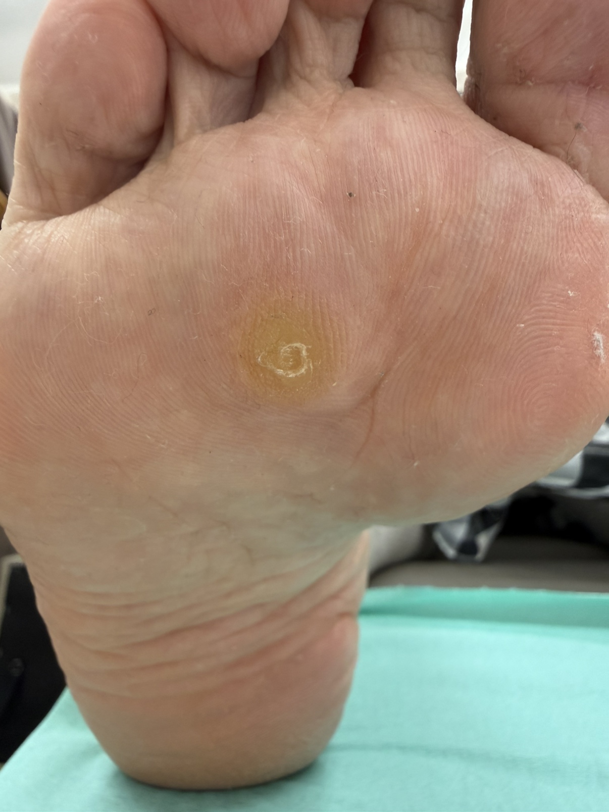 足裏にできた魚の目の写真
