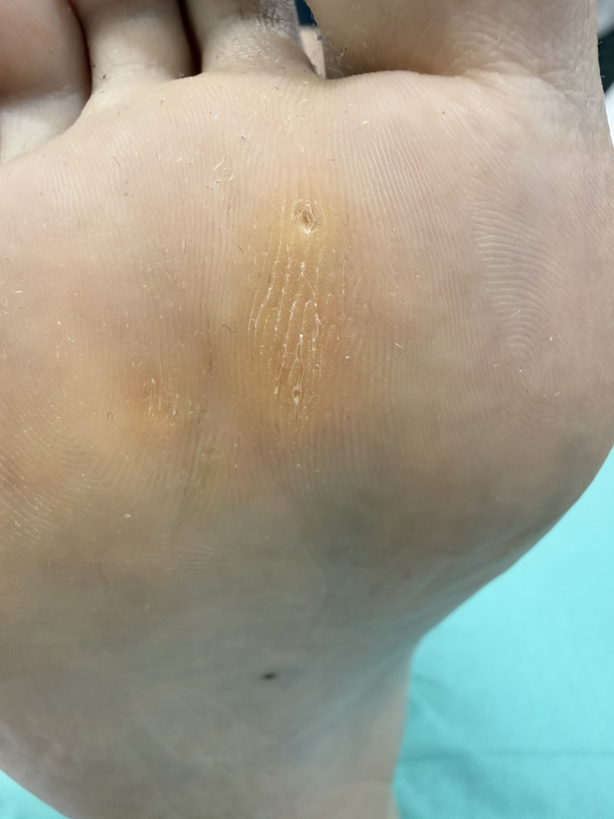 足裏の魚の目を拡大した写真