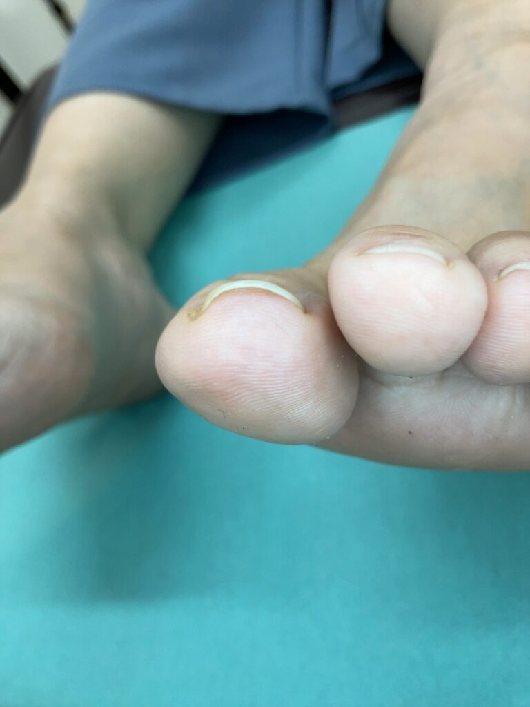爪の端が指の丸みに沿ってカーブし、爪溝のあたりにうっすら赤みが見られる初期の巻き爪の例