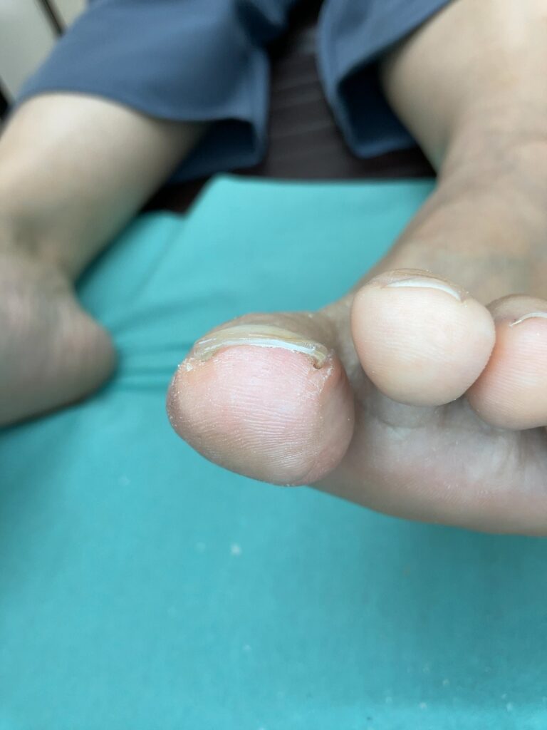 指の腹側から見た、深爪気味に整えたあとの初期の巻き爪の例