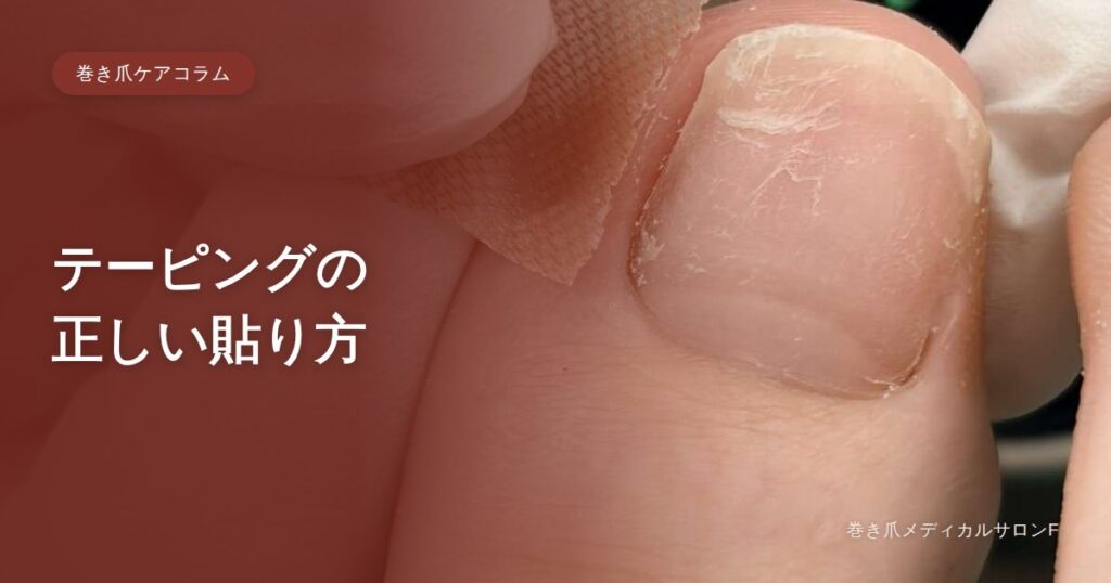 巻き爪ケアコラム テーピングの正しい貼り方