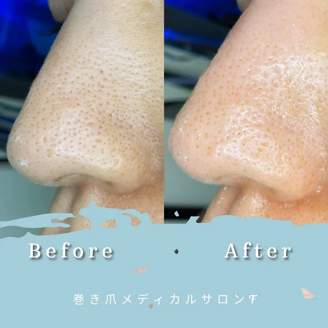 ハイドラフェイシャルの施術前と施術後の写真 1