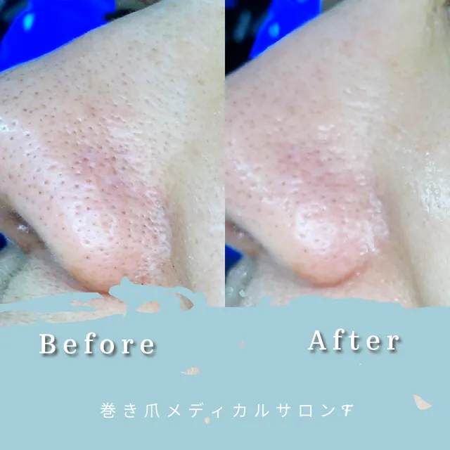 ハイドラフェイシャルの施術前と施術後の写真 2