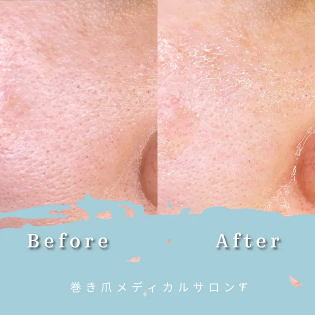 ハイドラフェイシャルの施術前と施術後の写真 3